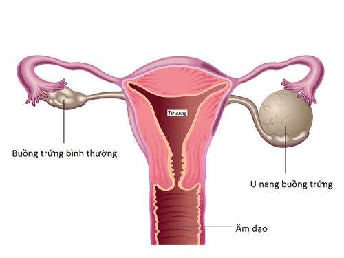 5 nguyên nhân cơ bản gây bệnh u nang buồng trứng 